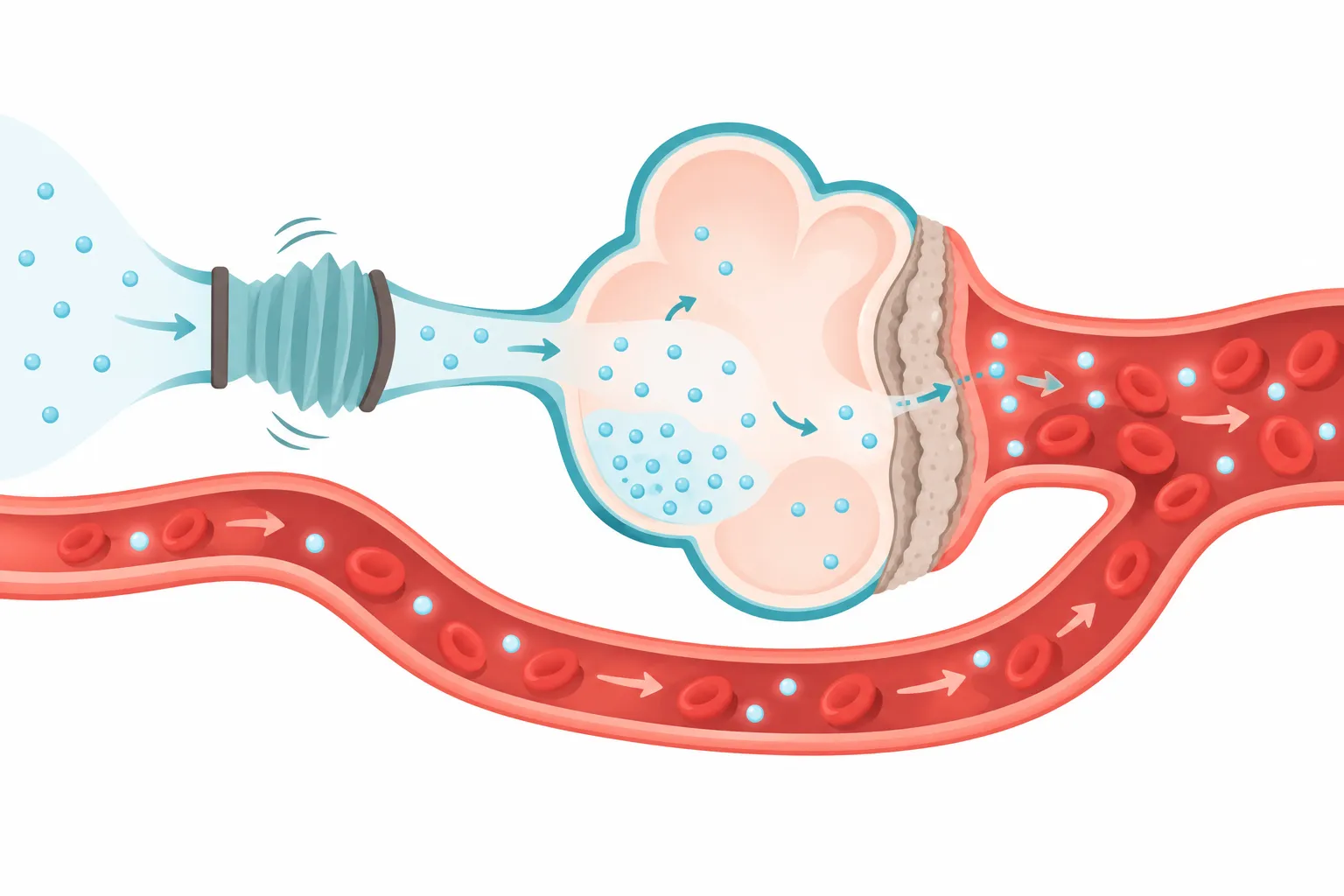 Caminho do oxigênio do ar até o sangue com cinco obstáculos: ar pobre em oxigênio, ventilação fraca, alvéolo desigual, desvio de sangue e parede espessada